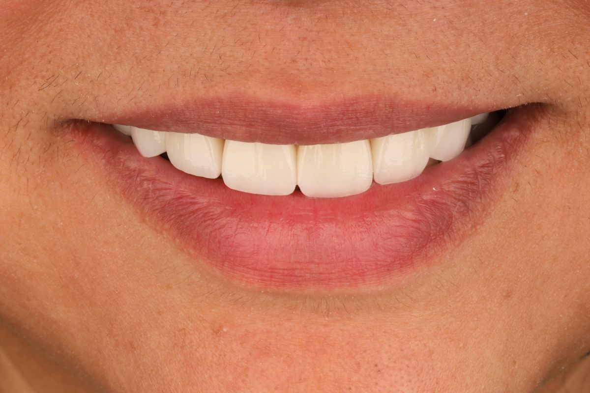 Natural Looking Veneers — after