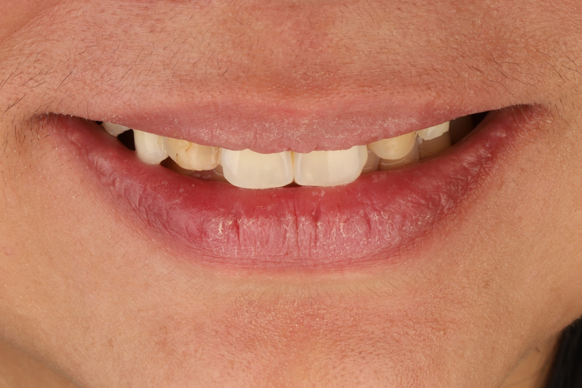 Natural Looking Veneers — before
